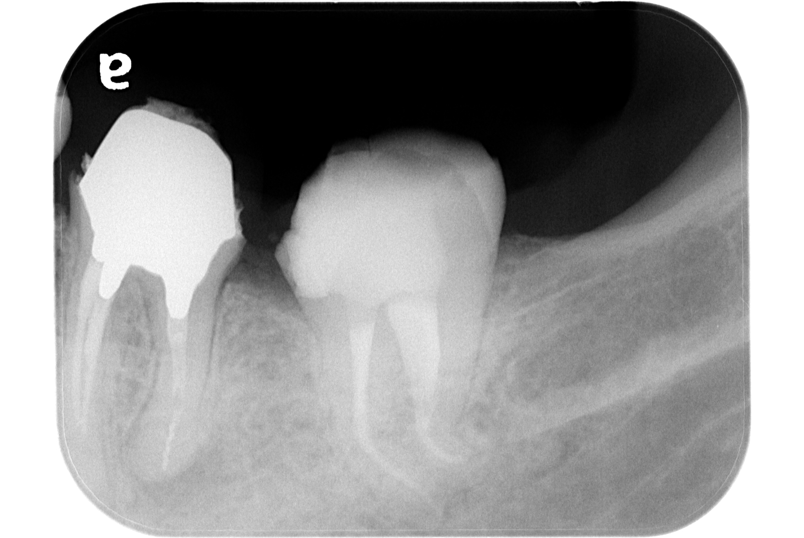 根管治療 治療後