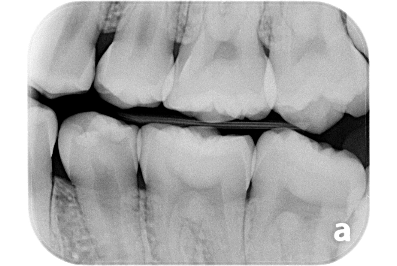 歯髄保存療法 治療前