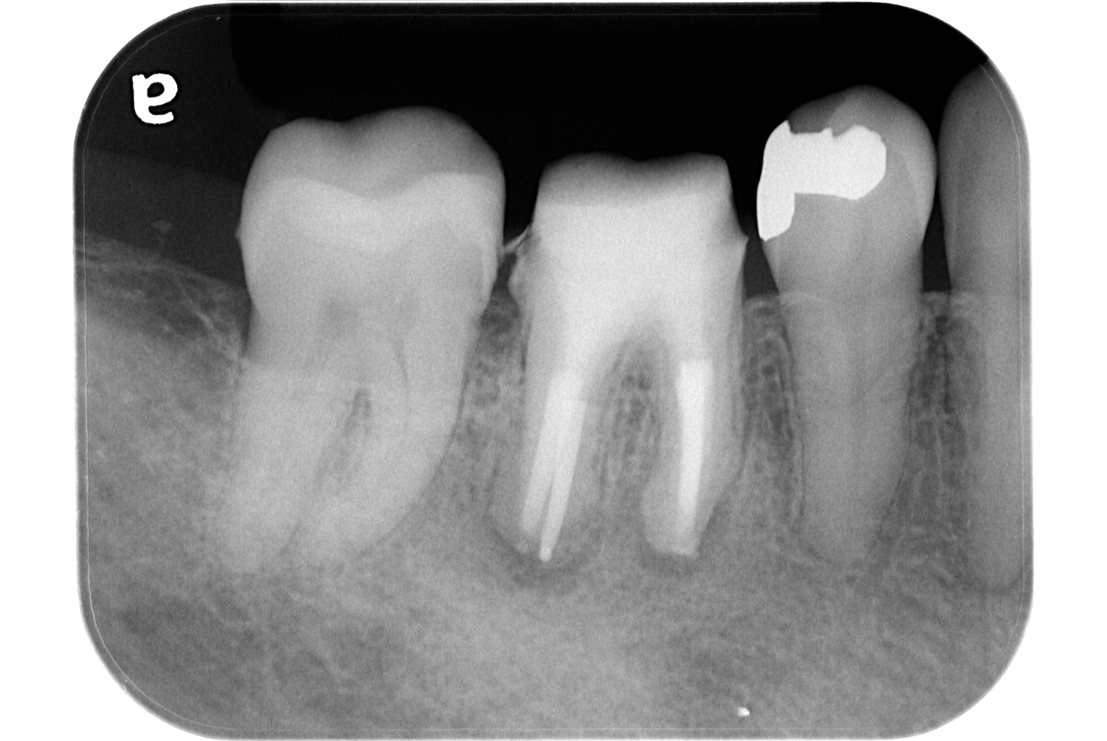 外科的歯内療法 治療前