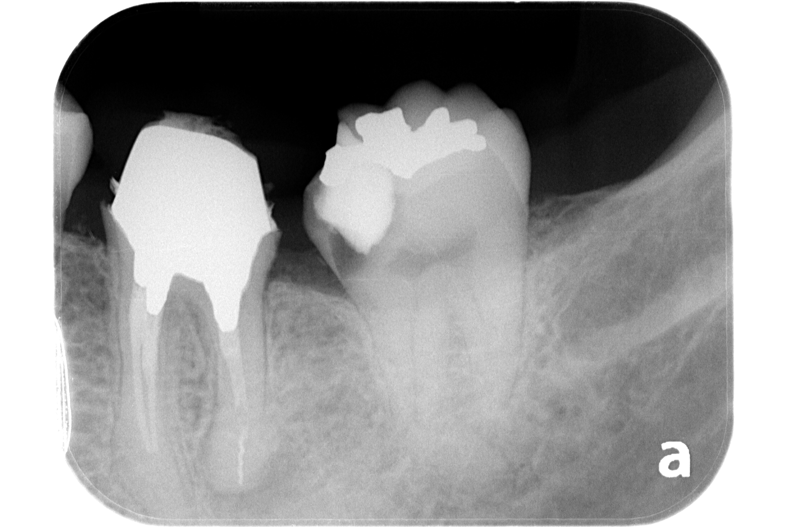 根管治療 治療前