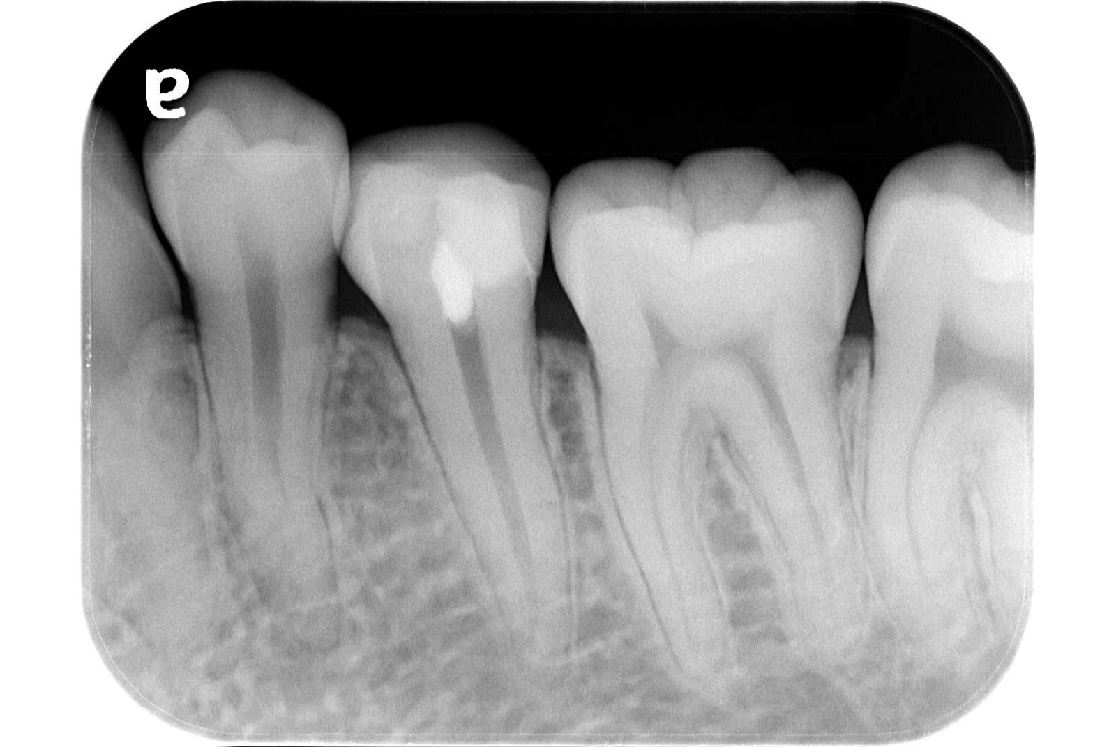 歯髄保存療法 治療後