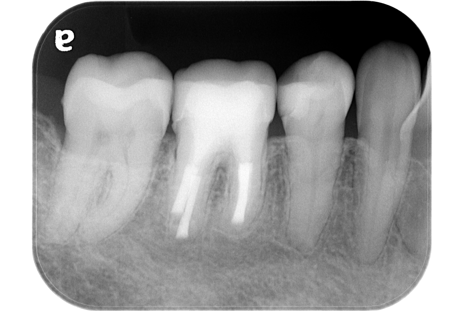 外科的歯内療法 治療後